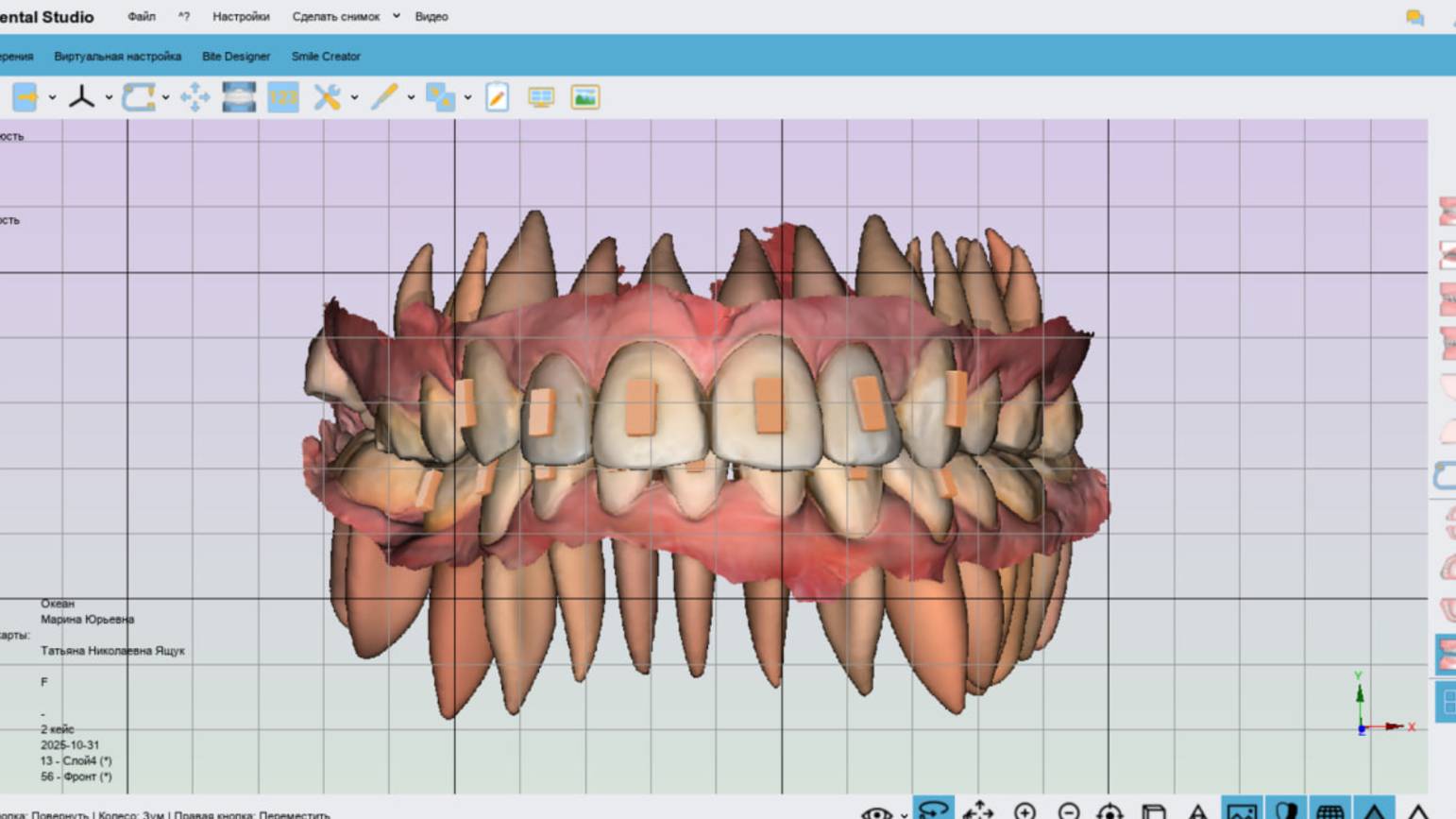 Maestro 3D. Полный цикл создания элайнеров. Кейс #2. Сложный случай.