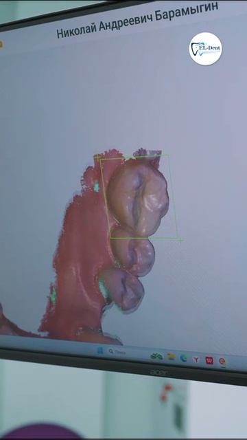 Коронки на передние зубы от клиники "Эл Дент". г. Якутск, ул. Кальвица 30