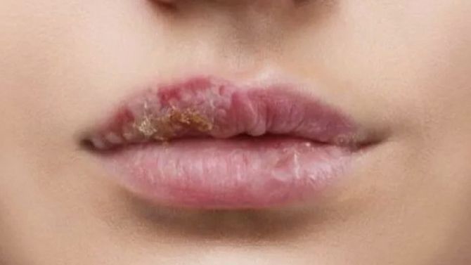 Герпес при беременности