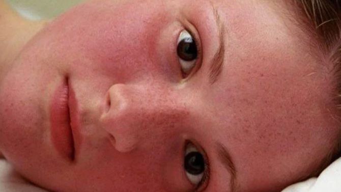 Краснуха при беременности