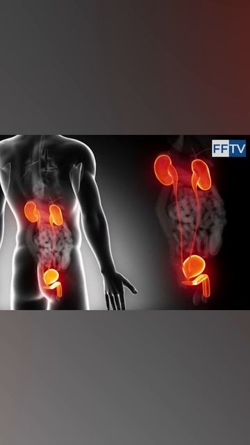 ЗАЧЕМ НУЖНА ОПЕРАЦИЯ ПРИ АДЕНОМЕ ПРЕДСТАТЕЛЬНОЙ ЖЕЛЕЗЫ #здоровье #медицина #аденомапростаты #shorts