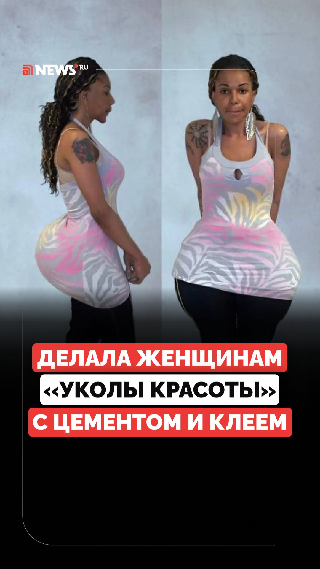 Хирург без лицензии. В США лжедоктор делала инъекции цемента и клея