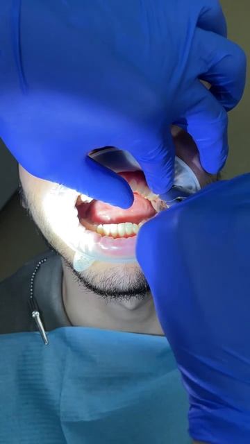 Удаление зуба мудрости в прямом эфире #стоматологиябезболи