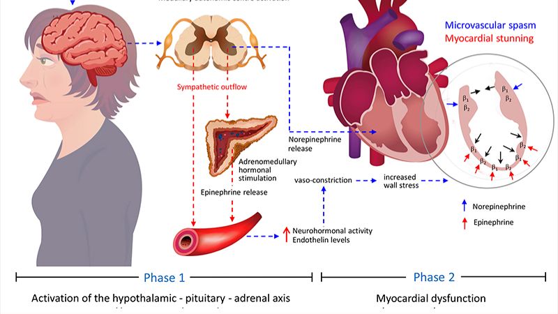 Синдром разбитого сердца - синдром Такоцубо. Br J Cardiol 2021;28:30–4