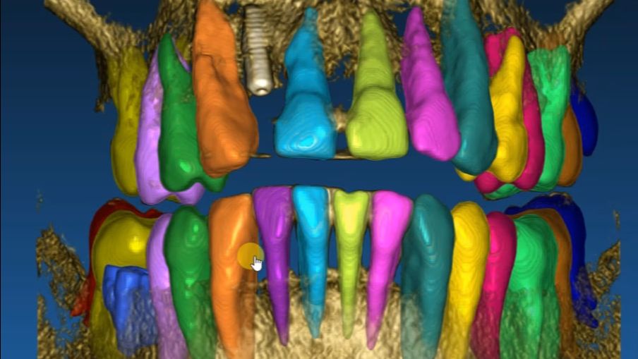 Сегментация корней из КТ для Maestro 3D.