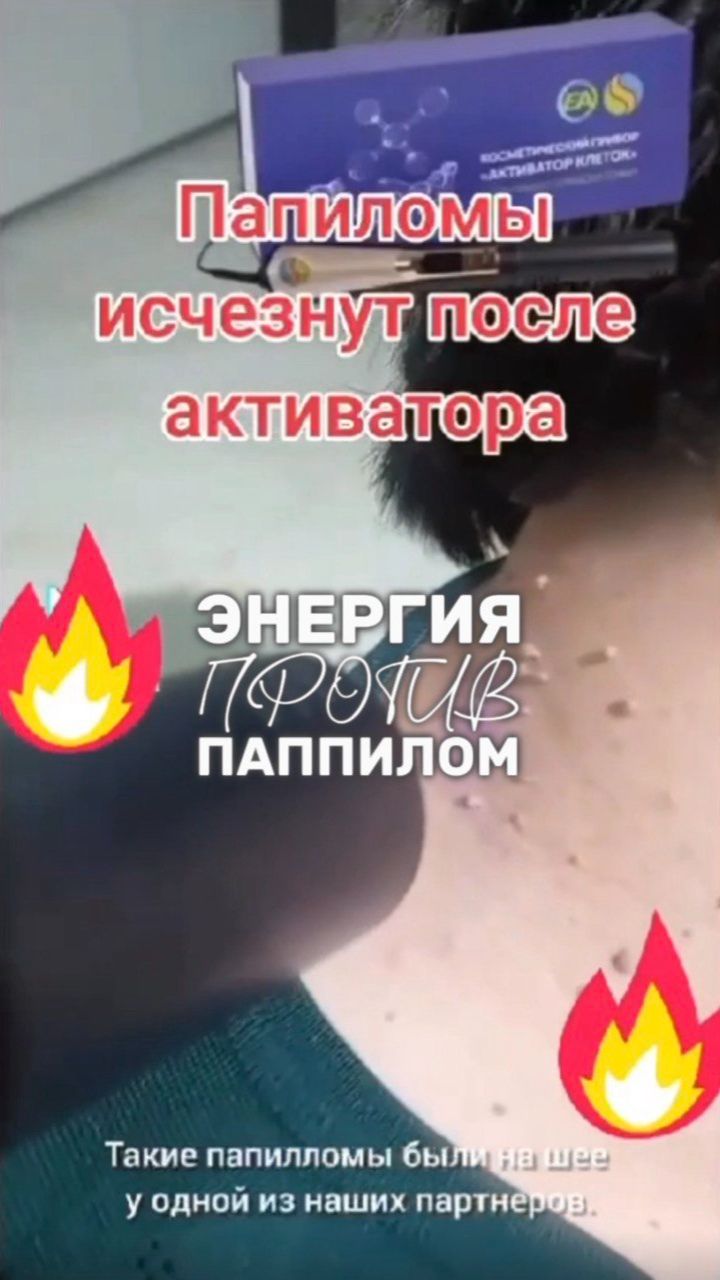 Как убрать папилломы легко и быстро? Читай описание