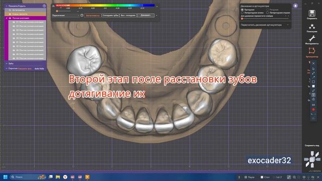 Мокап 35-45 ExoCad