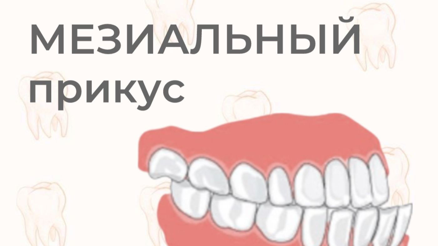 Мезиальный прикус