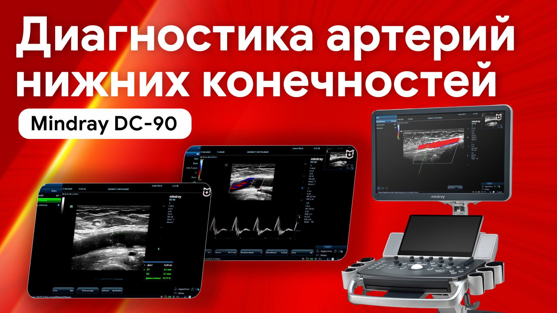 Артерии нижних конечностей: рутинное исследование на Mindray DC-90