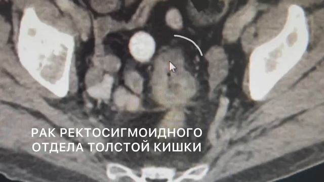 Локализация опухоли рака сигмоидного отдела прямой кишки (КТ до операции)