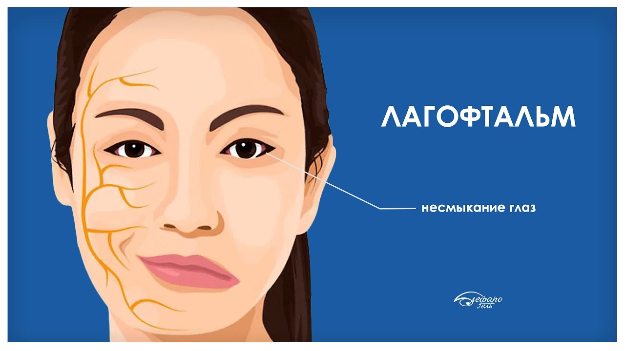 ЛАГОФТАЛЬМ: не закрываются глаза, что делать?