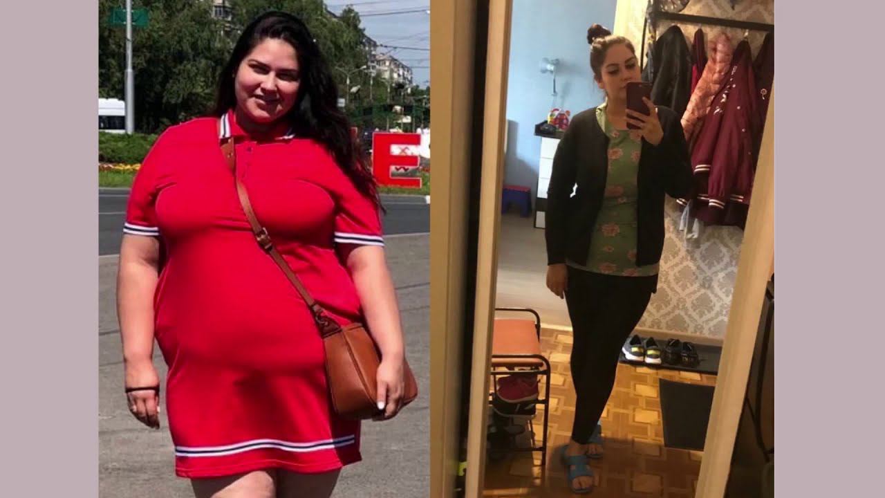 Бариатрические операции: до и после