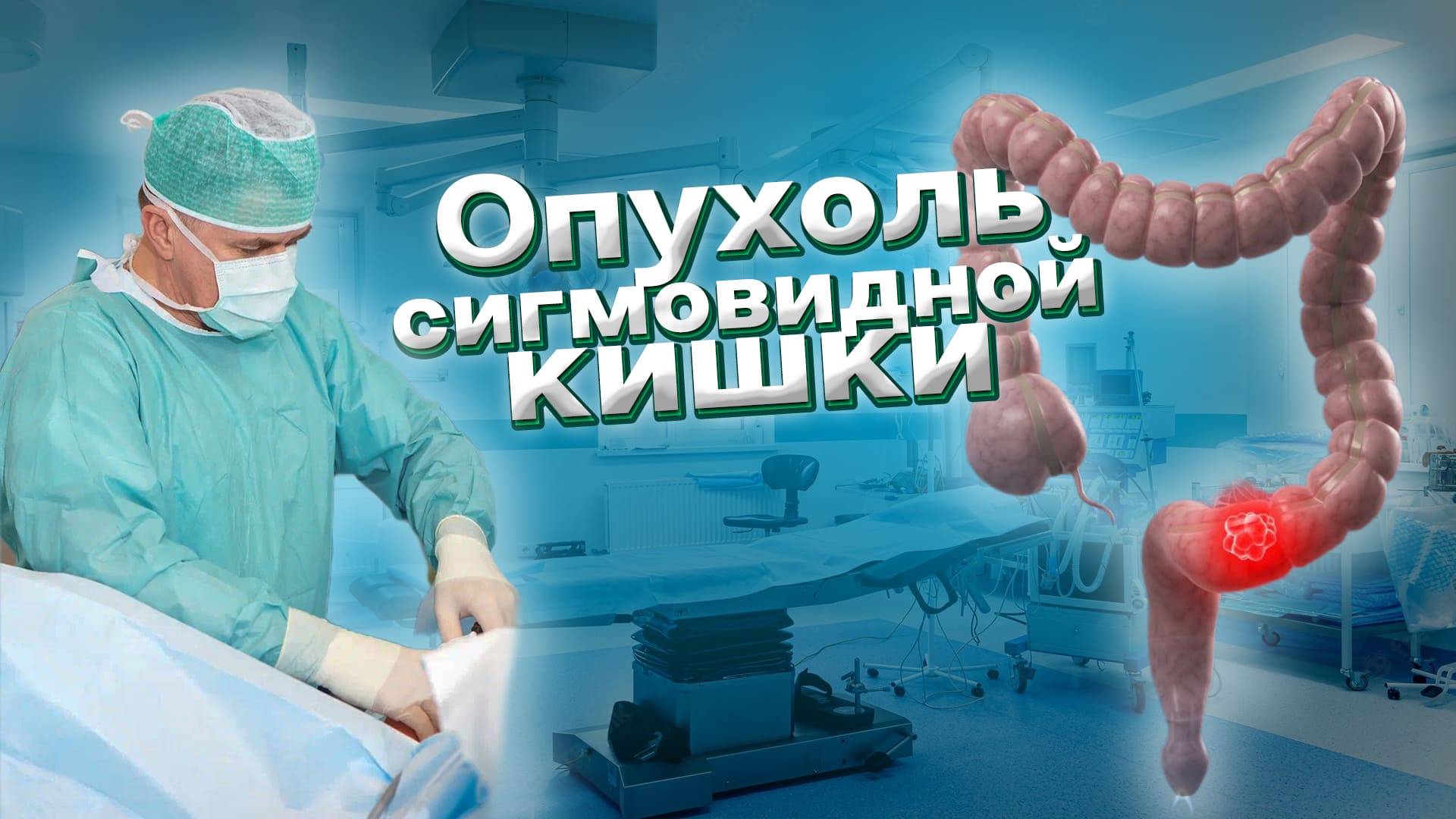 Опухоль сигмовидной кишки. Лапароскопическая резекция сигмовидной кишки. Полинеоплазия