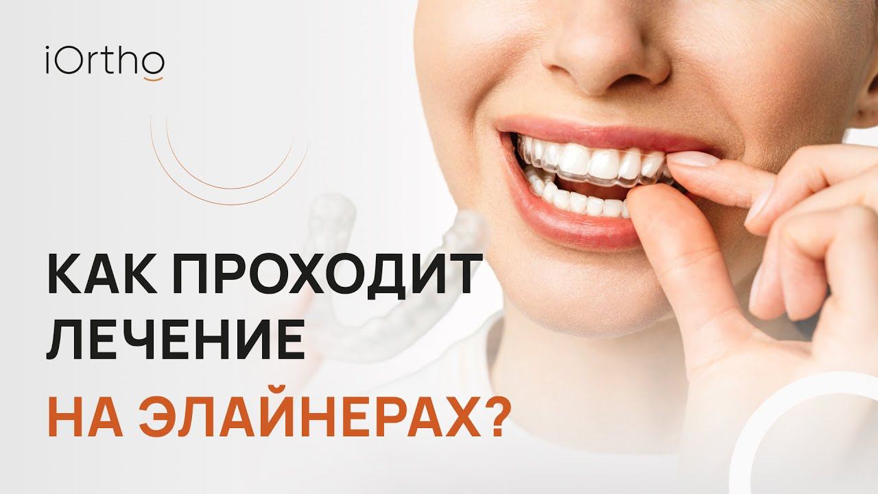 Как проходит лечение на элайнерах