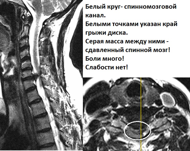 Огромная межпозвонковая грыжа диска в шейном отделе! Люберецкий центр позвоночника и суставов.