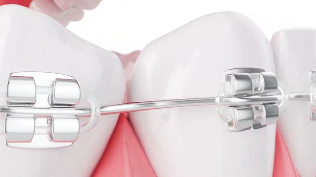 металлические брекеты