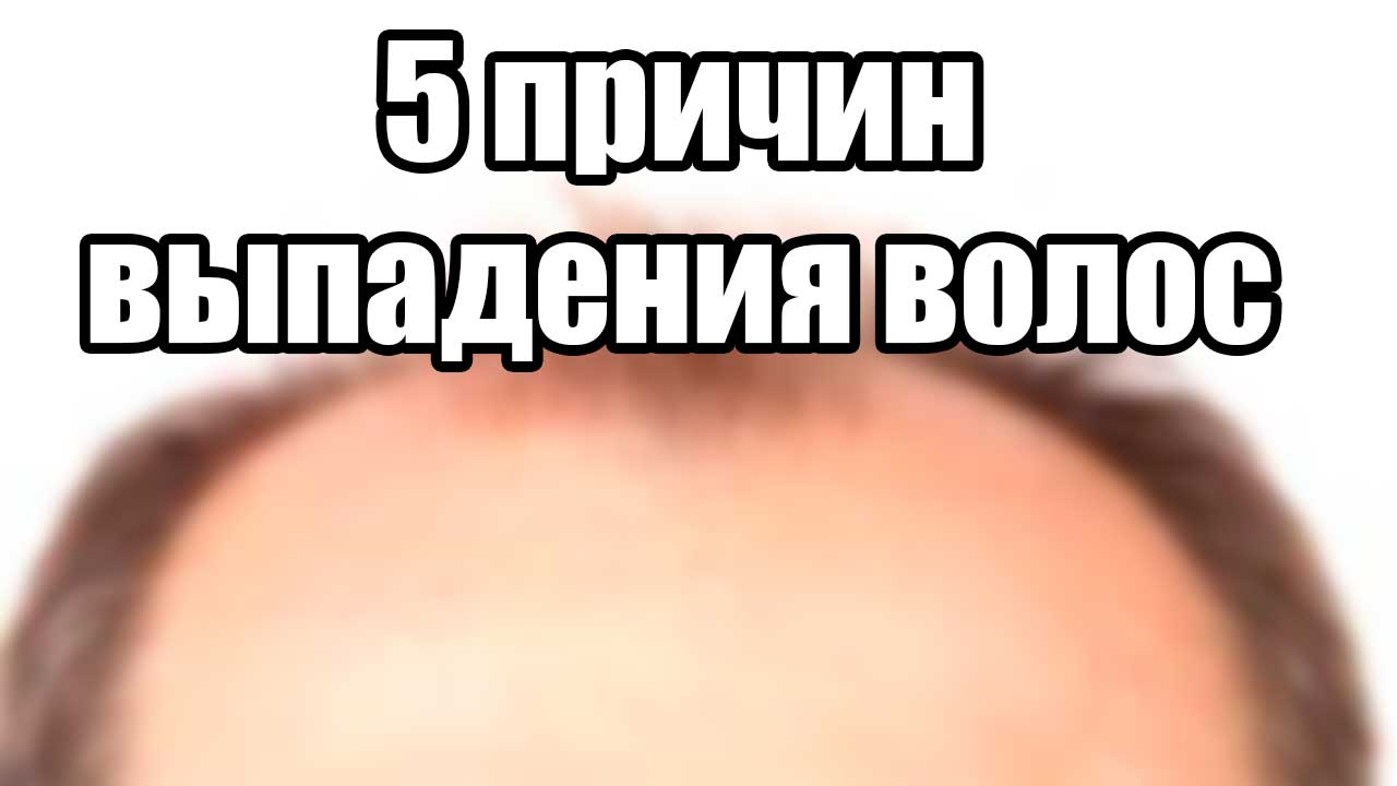 Причины выпадения волос. Облысение. Мужчины, женщины. Алопеция. Почему выпадают волосы. Залысина.