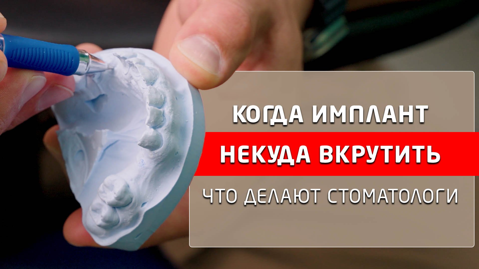 Синус-лифтинг, костная пластика нижней челюсти, зачем стоматологи делают это.