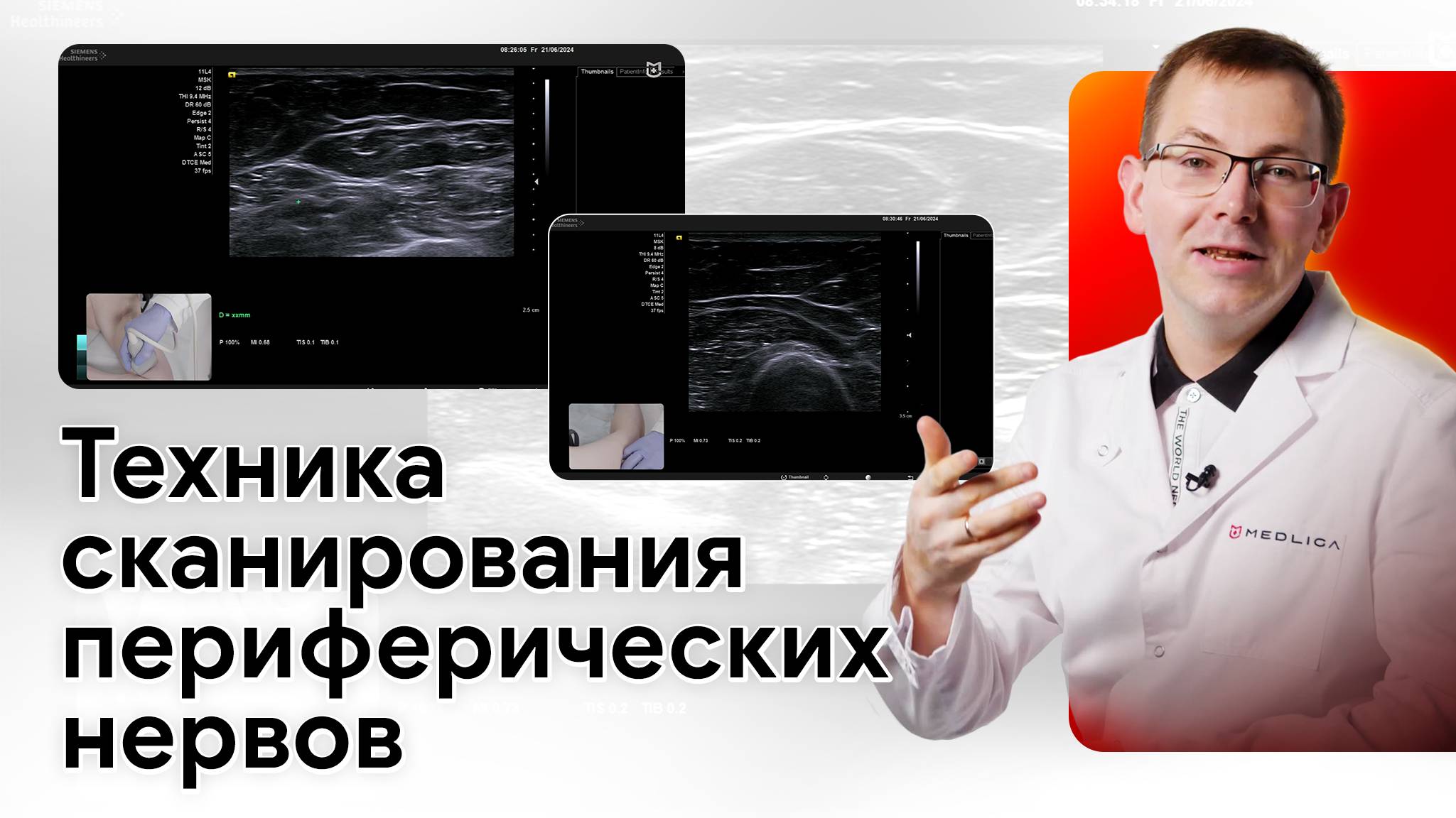 УЗИ периферических нервов верхних конечностей на Siemens NX3 Elite