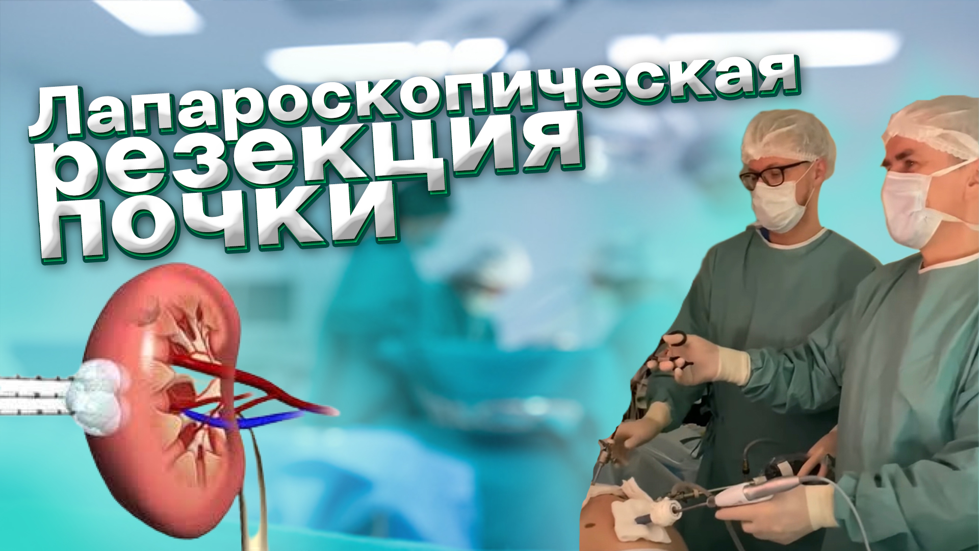 Лапароскопическая резекции почки. Лапароскопическая радикальная простатэктмия