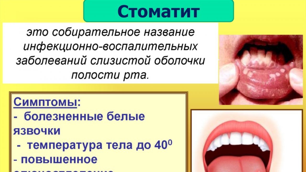 Стоматит. Что делать? Психосоматика