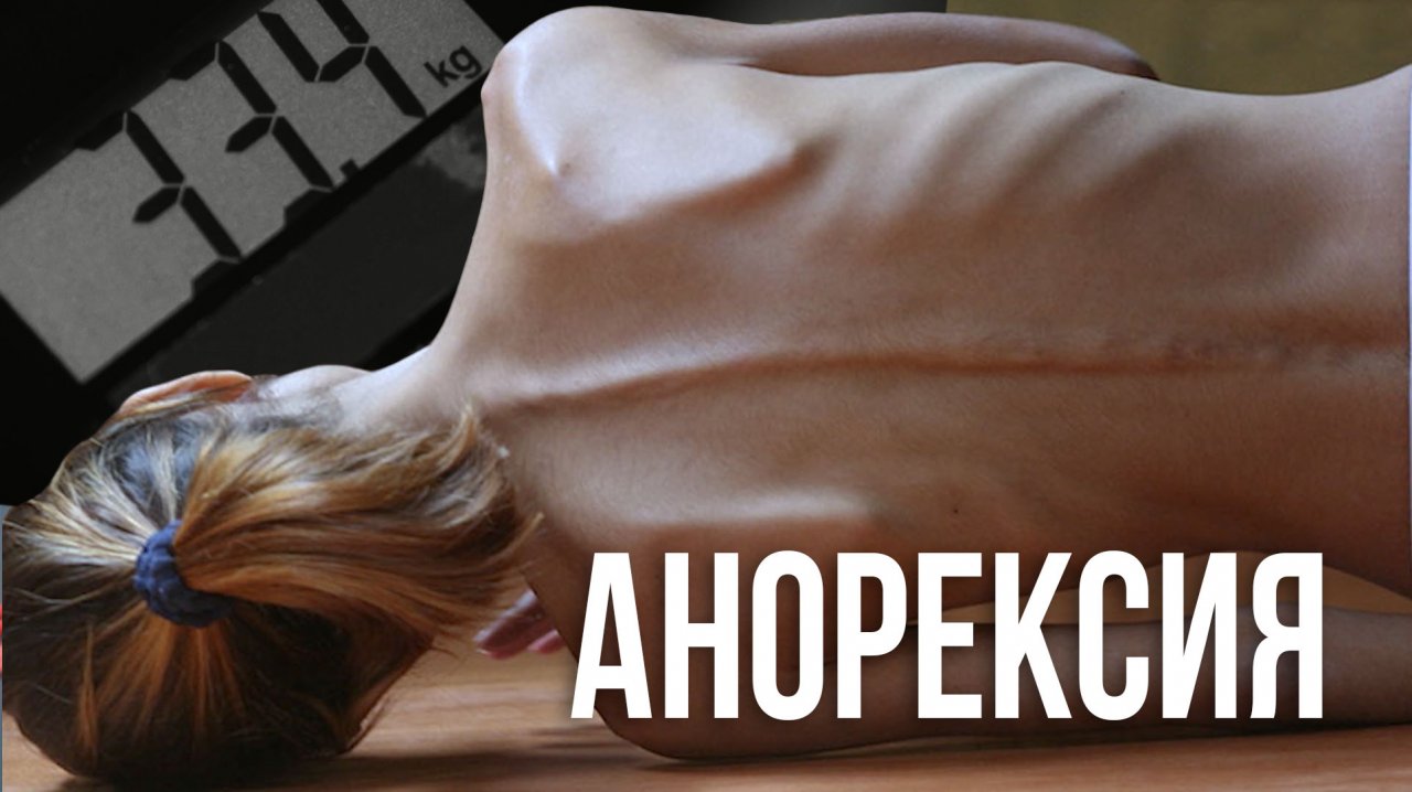 Что такое анорексия? Программа "ЗОЖ"